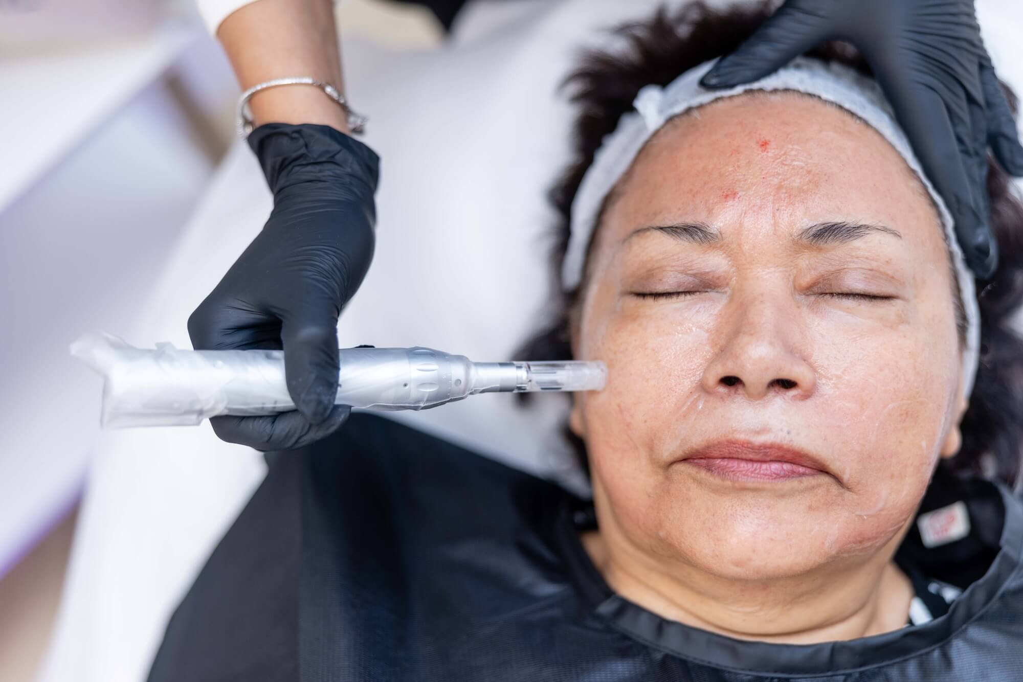 Microneedling + Exosomes Package of 4 Treatments