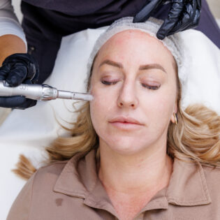 Microneedling Package of 4 Treatments